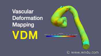 Medical Moment: How heart mapping detects aneurysms before they happen - WNDU