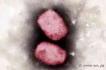 UKM: Zweiter Fall von Affenpocken