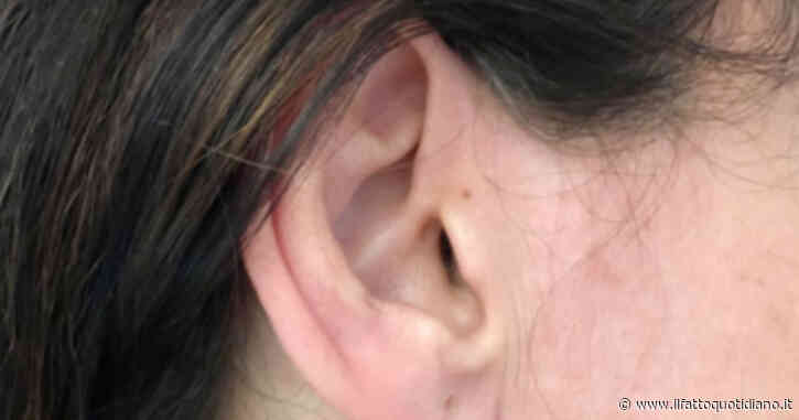 Primo trapianto di un orecchio in stampa 3D con cellule umane