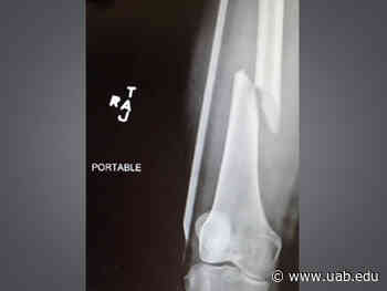 Getting back in the race after in-marathon femur fracture - News | UAB - University of Alabama at Birmingham