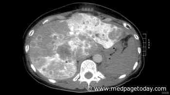 AI Shows Promise in Predicting Optimal Margin Width for CRC Liver Mets