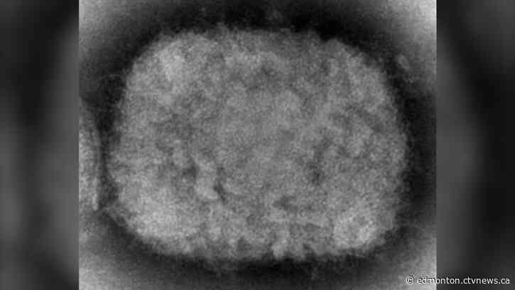 Alberta confirms first case of monkeypox