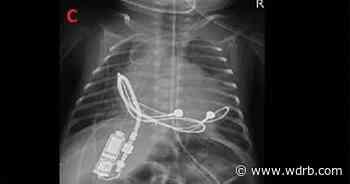 MEDICAL FIRST | Louisville doctors implant tiny pacemaker in 28-week-old infant - WDRB