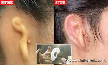 Woman gets a new 3D printed ear made from her own cells in world-first transplant 