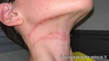 Cantiere mal segnalato a Marcon: ragazzo entra in bici, cade e si ferisce al collo - La Nuova Venezia