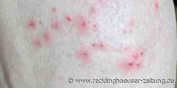 Die Einschläge kommen näher: Affenpocken im Kreis Coesfeld - Recklinghäuser Zeitung