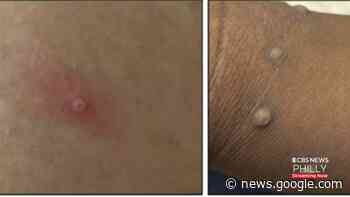 CDC Confirms Case Of Monkeypox In Philadelphia, First In Pennsylvania - CBS Philly