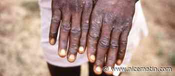 Variole du singe: 780 cas dans 27 pays non endémiques, selon l'OMS