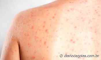 Trindade monitora caso suspeito de sarampo em bebê de 9 meses - Diário de Goiás