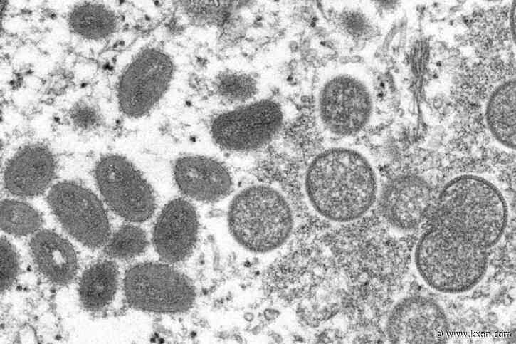 Monkeypox case reported in Texas, patient traveled internationally