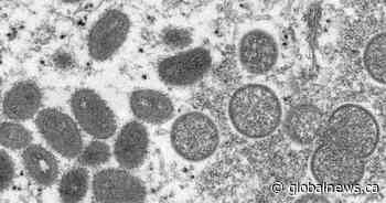 Alberta detects second case of monkeypox
