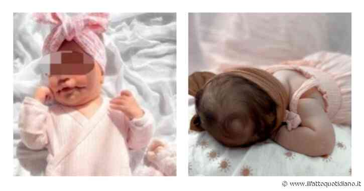 Cos’è la macrostomia bilaterale comunemente chiamata “sorriso perenne”: “Malformazione congenita rara. Bene intervenire con la chirurgia nei primi mesi di vita”