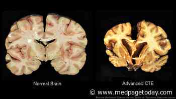 Evidence of CTE Rare in Military Personnel
