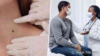 Products Marketed for Removing Moles and Other Skin Lesions Can Cause Injuries, Scarring