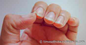 Coronavirus infection: Telltale signs of COVID in nails; know why you should not ignore it - Times of India