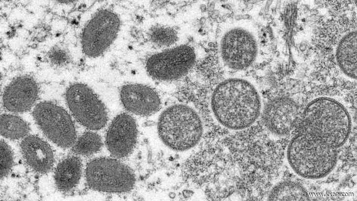 Monkeypox cases more than double in US, 1 case now in Texas