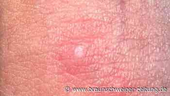 Affenpocken: WHO bestätigt Wirksamkeit von Pockenimpfung