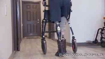 Edmonton clinic specializing in osseointegrated prosthetics - CTV News Edmonton