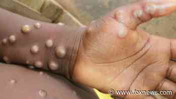 Monkeypox detected in first US military service member at Germany base