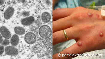 Brasil tem primeiro caso de varíola dos macacos confirmado - portalextremoz.com.br