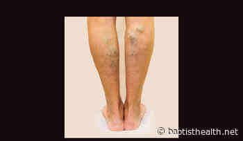Beyond Varicose Veins: Treating Both Medical, Cosmetic Issues Comprehensively at the Vein Clinic at Boca Raton Regional Hospital - Baptist Health South Florida
