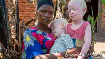 Gesellschaft - Aberglaube und Ausgrenzung: Albinismus bleibt ein Stigma - Neue Presse Coburg