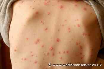 Calamine chickenpox lotion shortage as cases rise