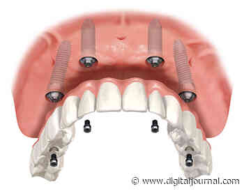 Dr. Theo Spyrakis From Bexley Dental Is Educating Patients On The Topic – What Is All On 4 - Digital Journal