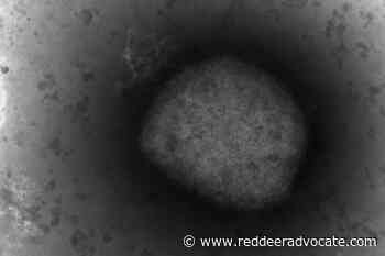 Canadian heading World Health Organization’s fight against monkeypox - Red Deer Advocate