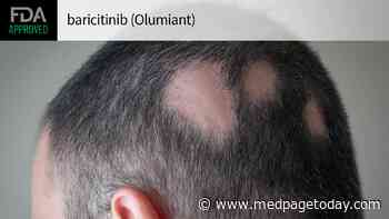 FDA Approves First Systemic Treatment for Alopecia Areata