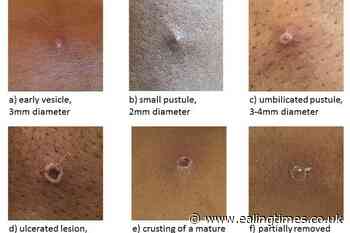 Monkeypox cases in the UK reach 470 - Ealing Times