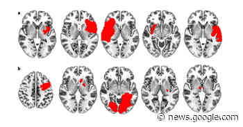 They Were Cigarette Smokers. Then a Stroke Vanquished Their Addiction. - The New York Times