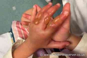 UK parents issued warning as Giant Hogweed leaves child with second degree burns