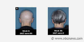 FDA approves first alopecia treatment for condition that causes sudden hair loss
