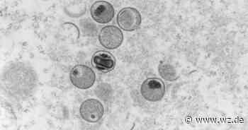 Affenpocken: Weiterer Fall in Aachen aufgetreten - Westdeutsche Zeitung