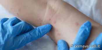 Vaiolo delle scimmie: primo caso in Piemonte - Prima Vercelli