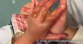 Child hospitalised with second-degree burns after touching dangerous plant - Grimsby Live