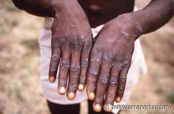 Massachusetts Department of Public Health reveal more cases of monkeypox - Fall River Reporter