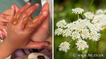 Giant hogweed warning as girl, 4, suffers horrific burns while playing in park - LBC