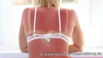 Hitzewelle in Hamburg: Was tun bei Sonnenbrand und Sonnenstich?