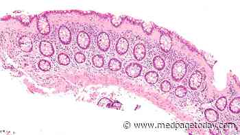 Appendectomy Linked to Higher Risk of Microscopic Colitis