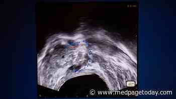 MRI-Guided HIFU Effective in Intermediate-Risk Prostate Cancer