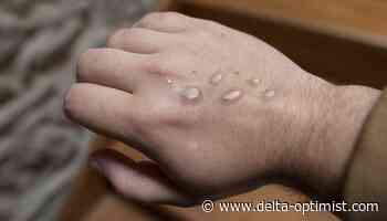 BC reports second case of monkeypox - Delta Optimist