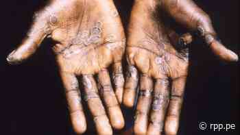 Brasil iguala a México con cinco casos de viruela del mono confirmados - RPP Noticias