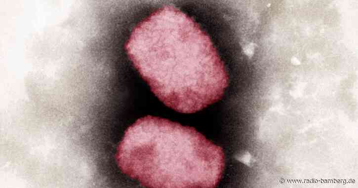 Studie: Zahlreiche Mutationen bei Affenpocken-Erreger