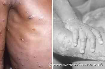 Monkeypox cases in Hertfordshire rise to eight