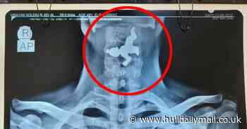 Doctor's unusual find after man rushed to hospital struggling for breath - Hull Live