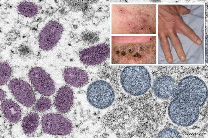 Monkeypox mutates at unprecedented rate with 'accelerated evolution,' study finds - New York Post