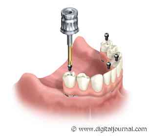 Bexley Dental Elucidates on Full Mouth Dental Implants and the All on 4 Technique - Digital Journal