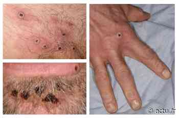 Lyon. Contaminé par le Covid, puis la variole du singe : « je n’ai plus le droit de sortir » - actu.fr